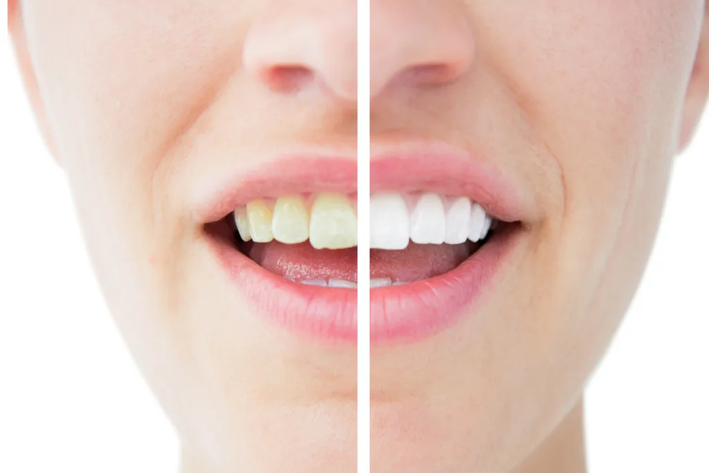 Jakie są przyczyn żółknięcia zębów