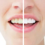 Jakie są przyczyn żółknięcia zębów